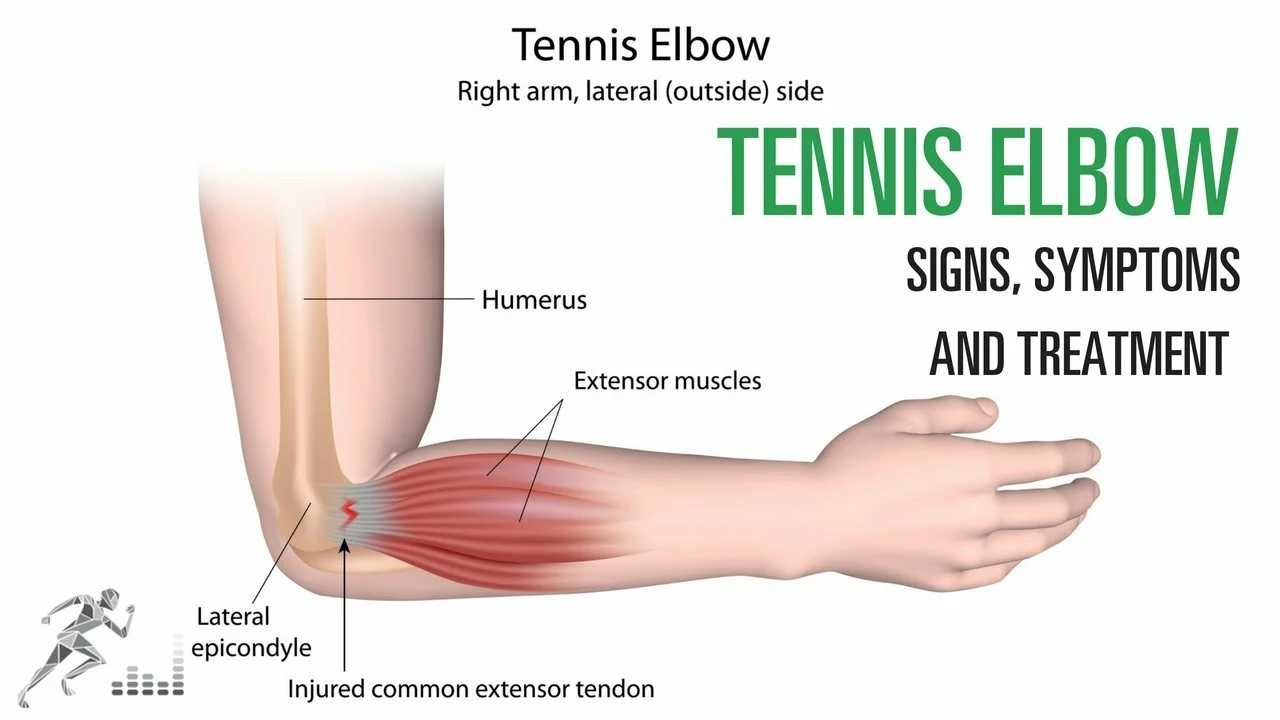 What is the best non-medical treatment for tennis elbow?